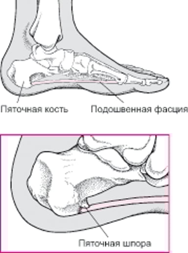 Что такое пяточная шпора?