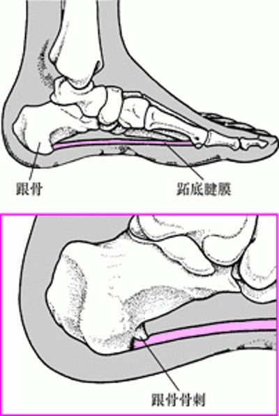 什么是跟骨骨刺？