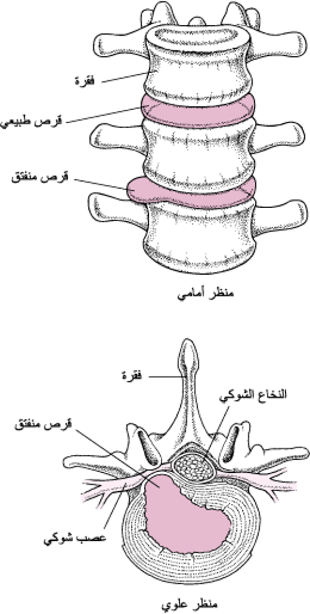 انفتاق القرص