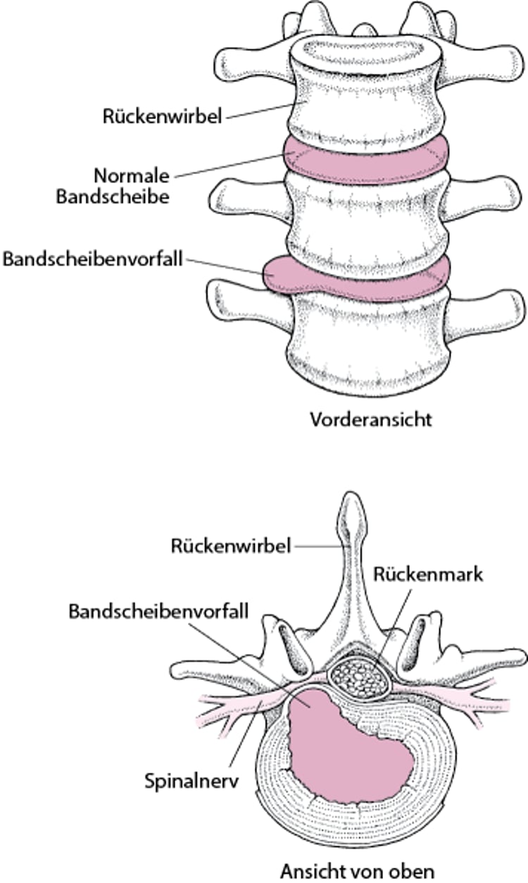 Ein Bandscheibenvorfall