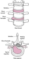 Hernia de disco