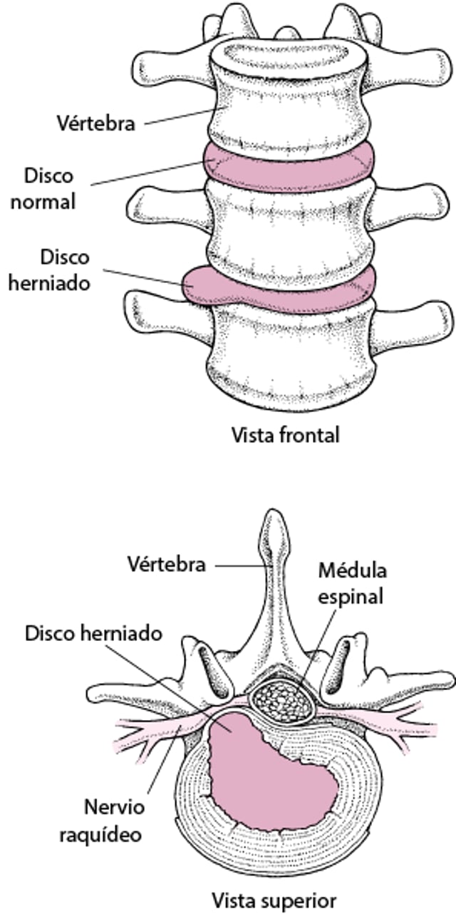 Hernia de disco