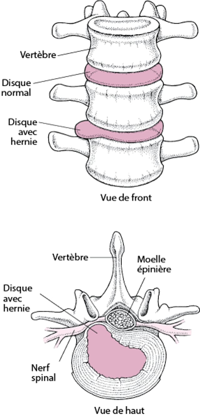 Une hernie discale