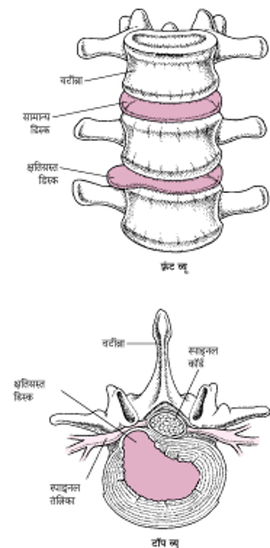 कोई हर्निएटेड डिस्क