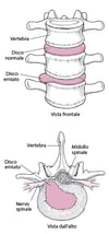 Ernia discale