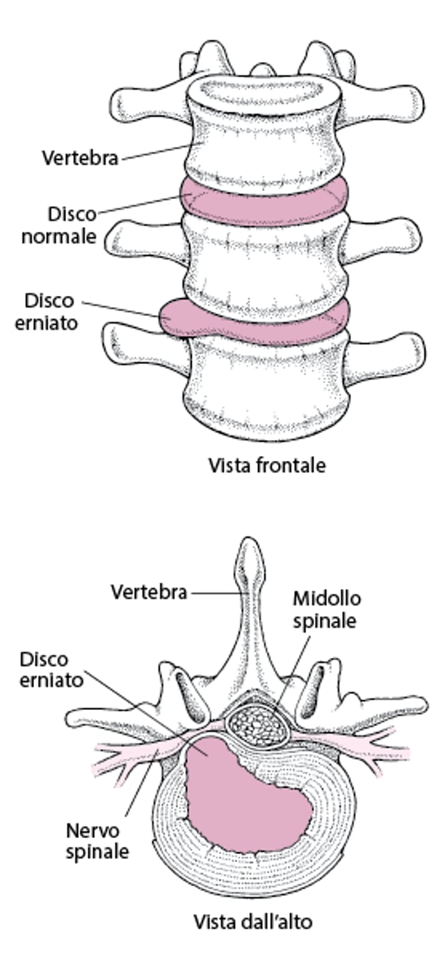 Disco erniato