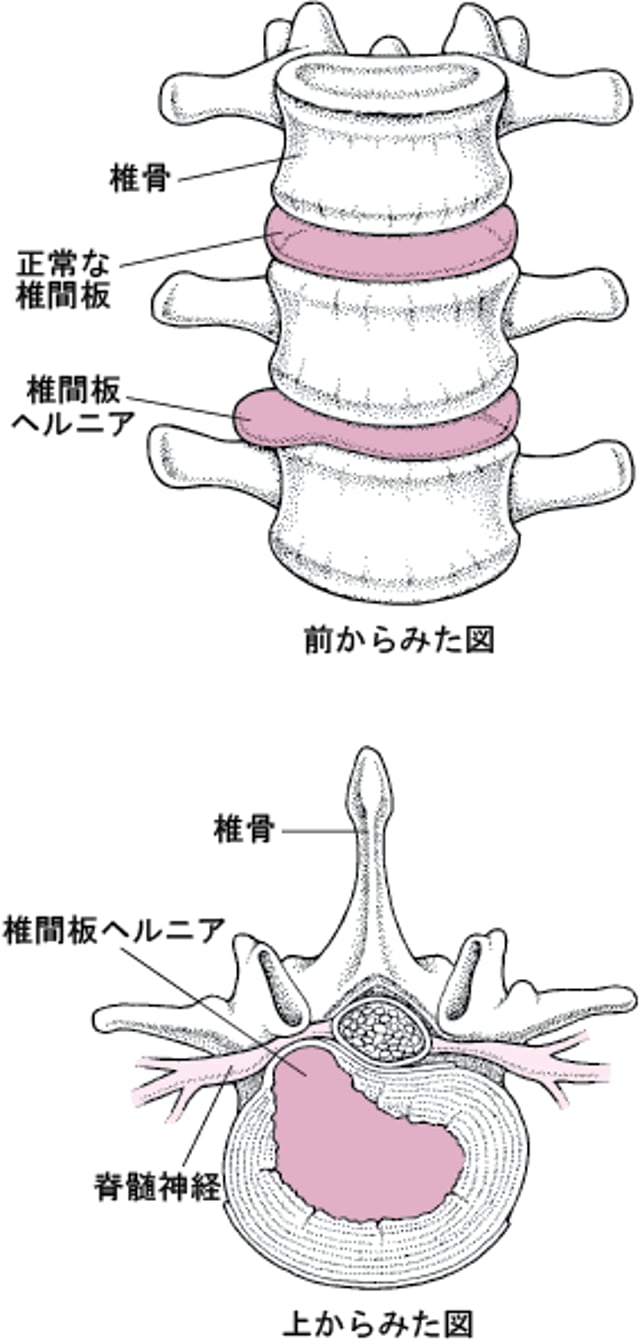 椎間板ヘルニア