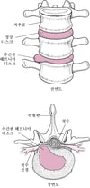 추간판 탈출