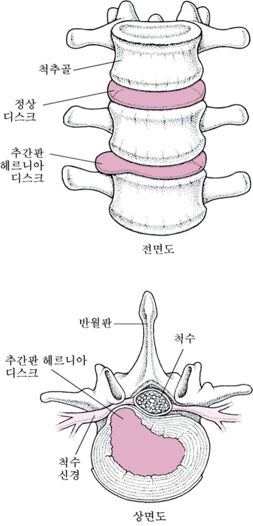 탈출 추간판