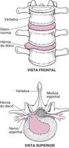 Um disco herniado