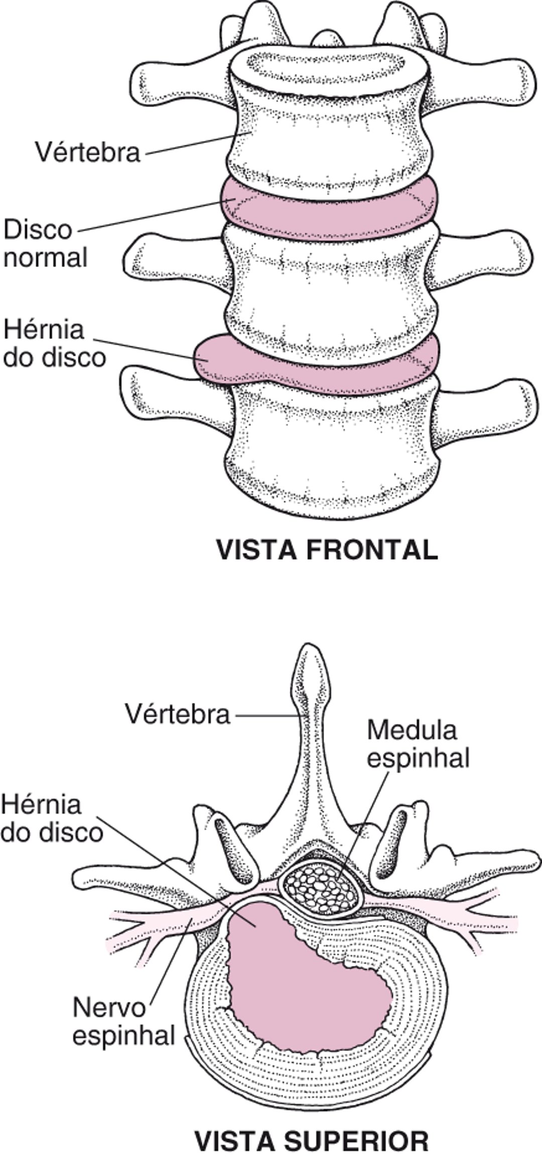 Um disco herniado