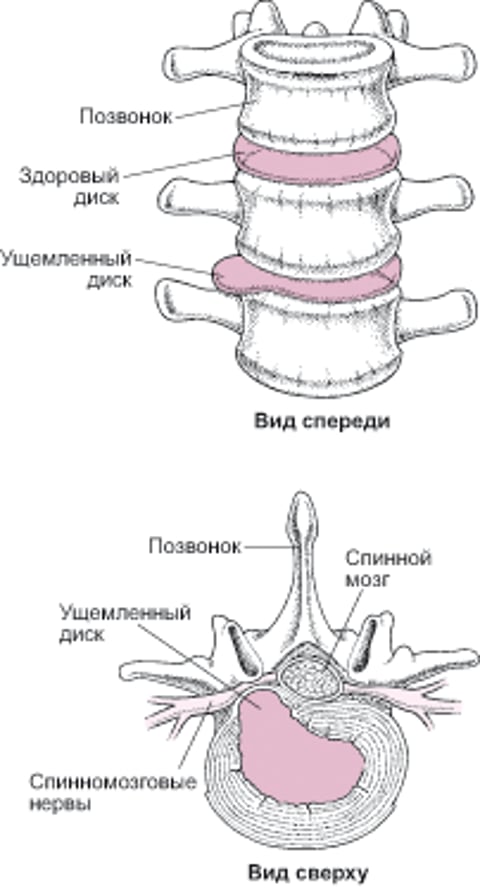 Грыжа межпозвоночного диска
