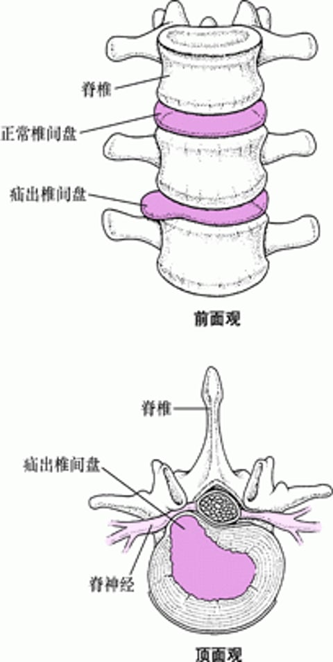 突出的椎间盘