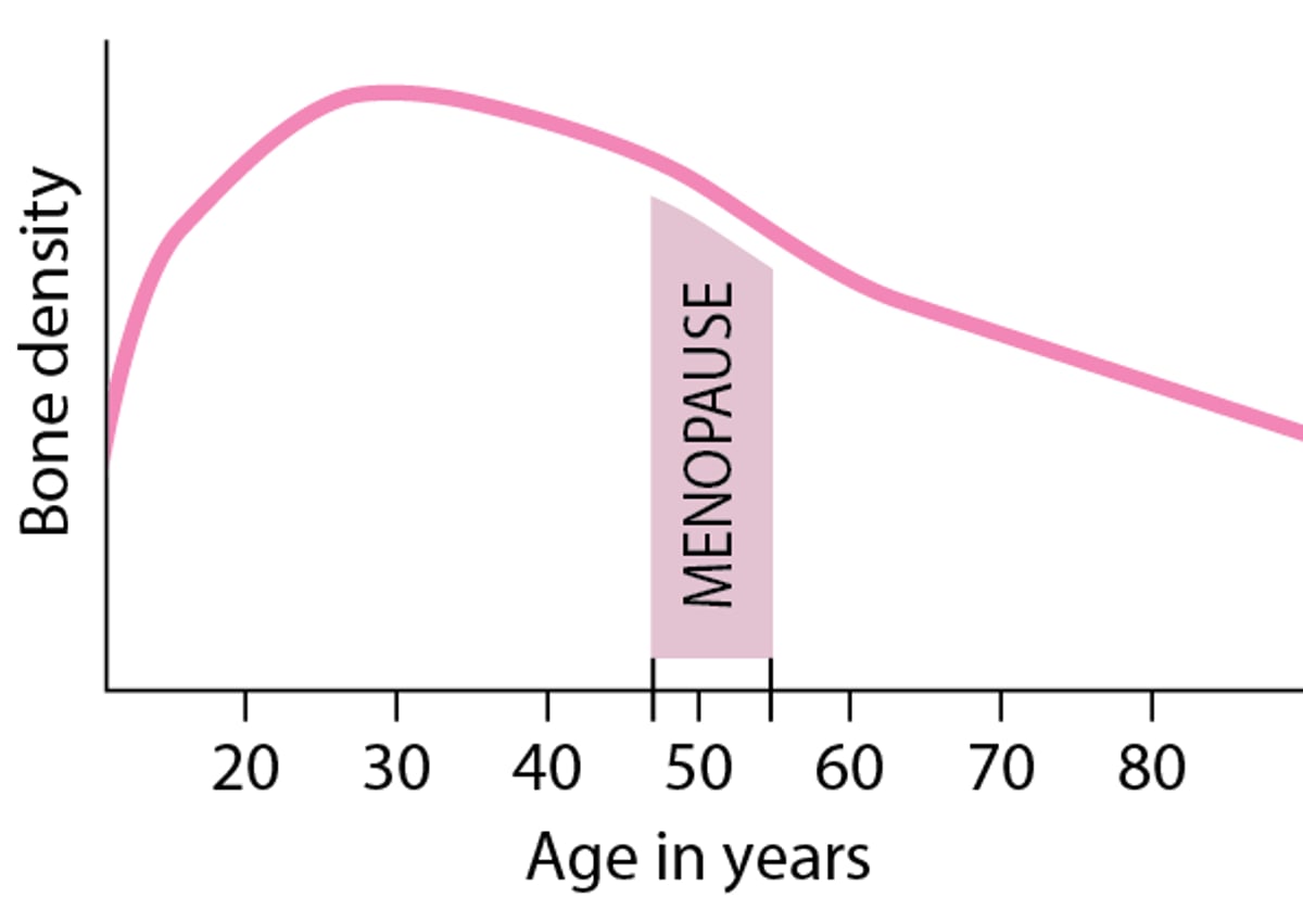 Loss of Bone Density in Women