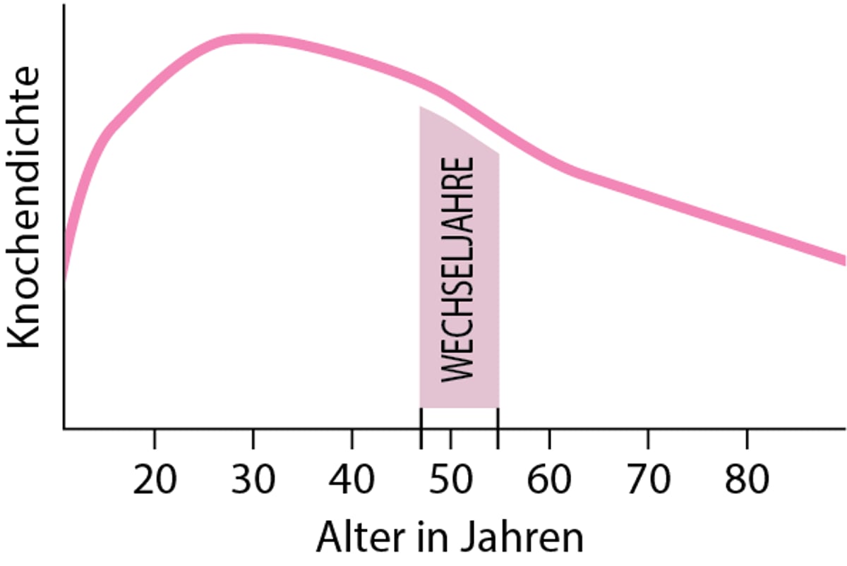 Verlust der Knochendichte bei Frauen