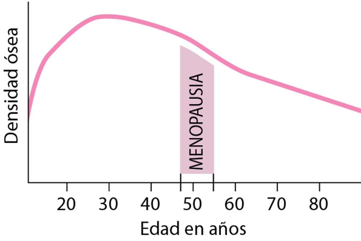 Pérdida de densidad ósea en mujeres