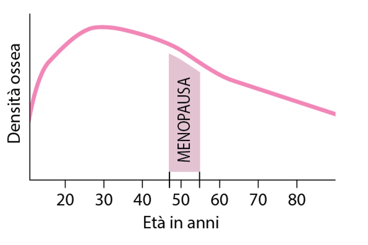 Perdita della densità ossea nelle donne