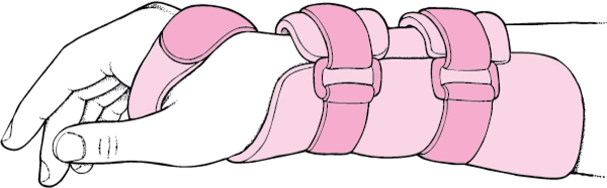 手腕夹板