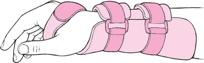 手腕夹板