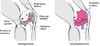 Replacing a Knee