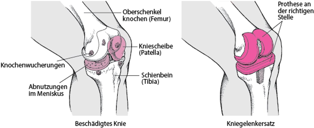 Kniegelenkersatz