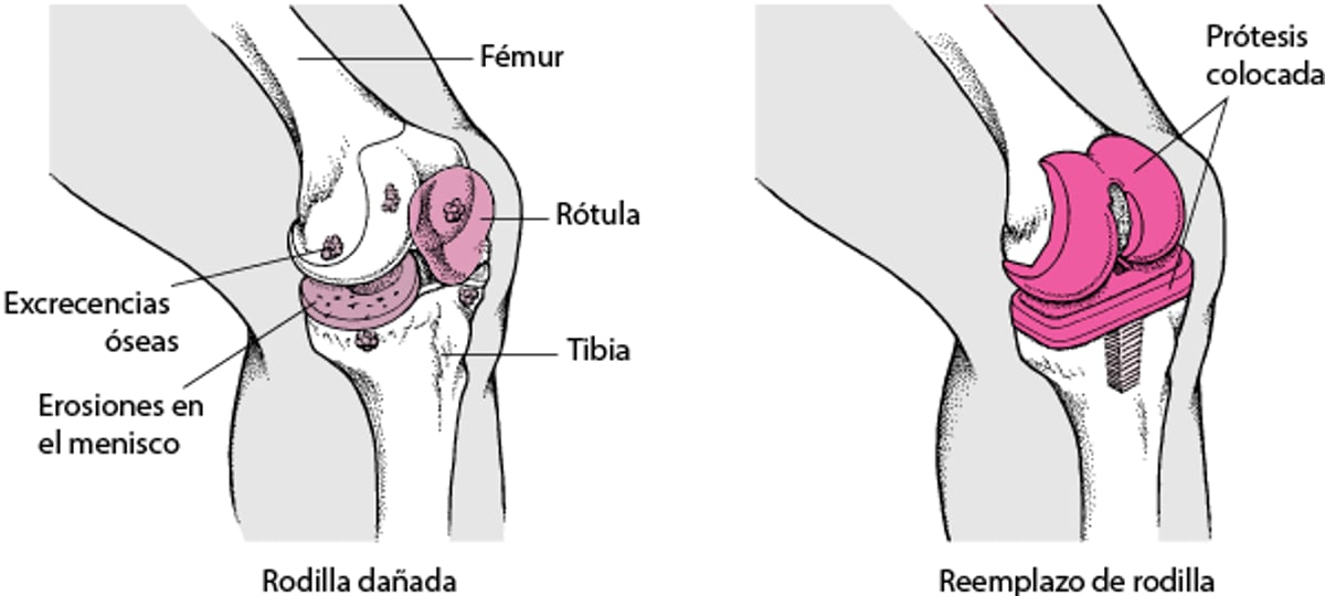 Sustitución de rodilla