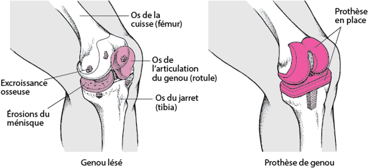 Remplacement d’un genou