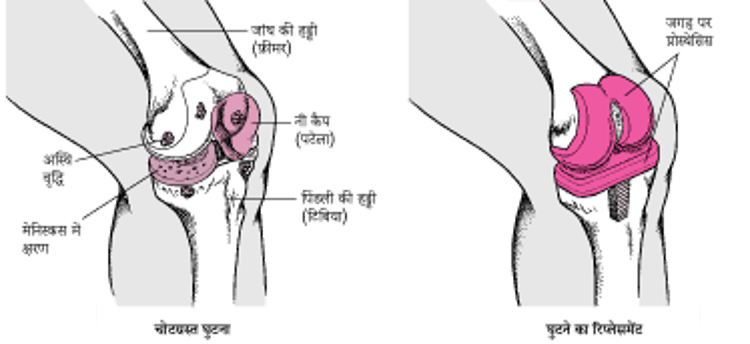 घुटना रिप्लेस करना
