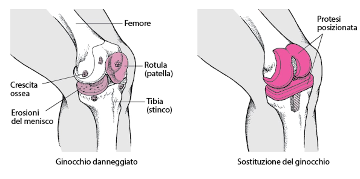 Sostituzione del ginocchio