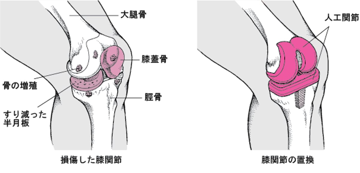 膝関節の置換手術