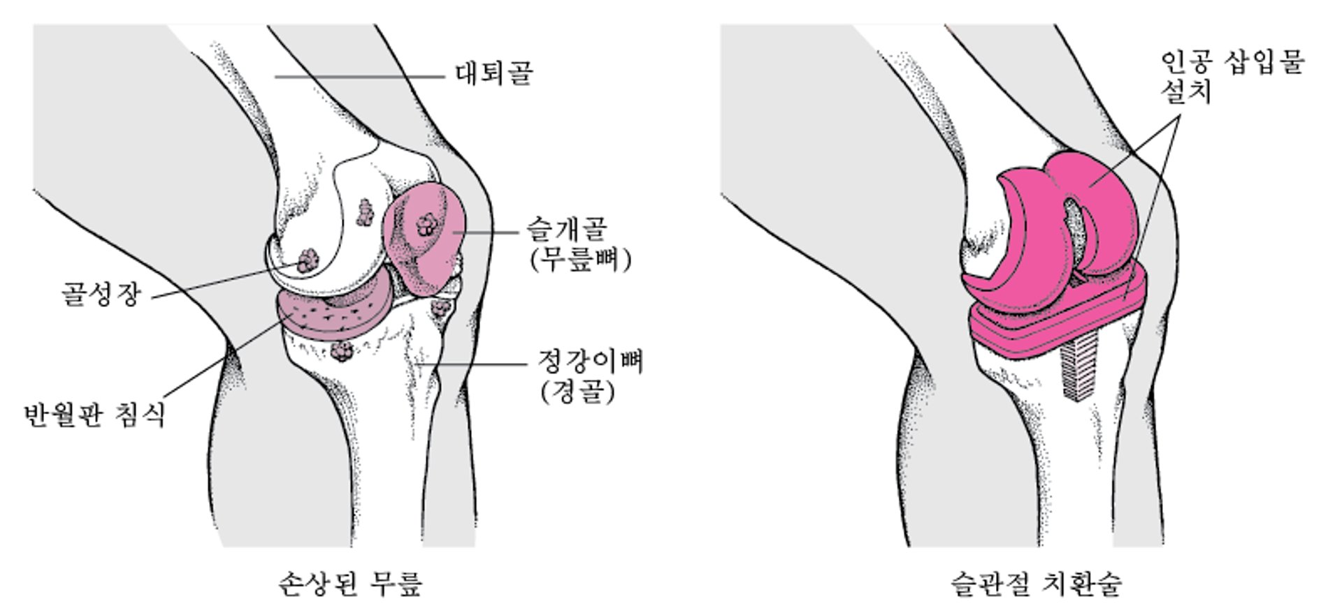 무릎 치환