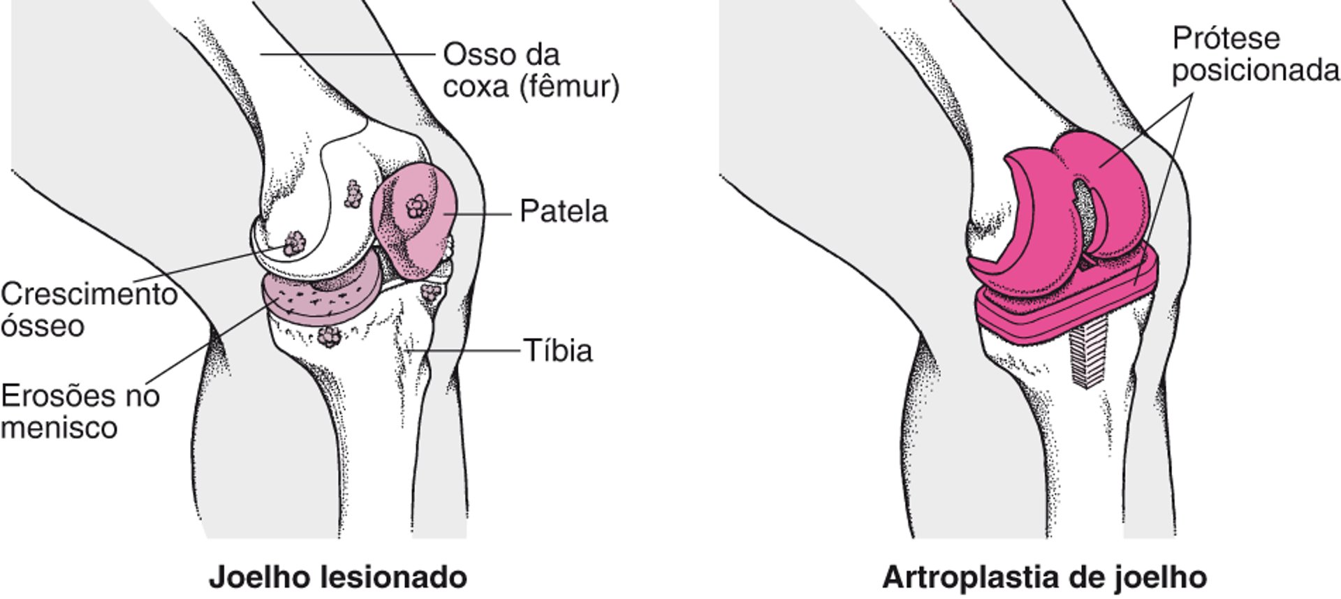 Substituição de joelho