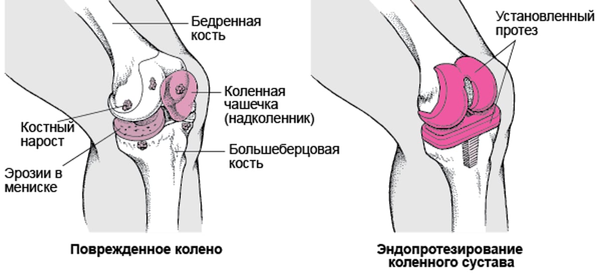 Эндопротезирование коленного сустава