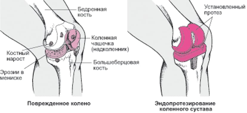 Эндопротезирование коленного сустава