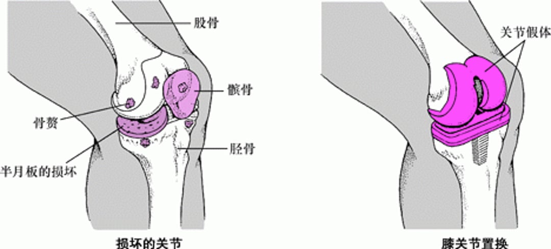置换膝关节