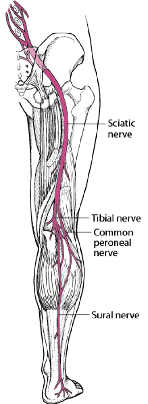 Sciatica