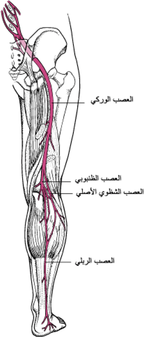 عرق النسا (التهاب العصب الوركي) Sciatica
