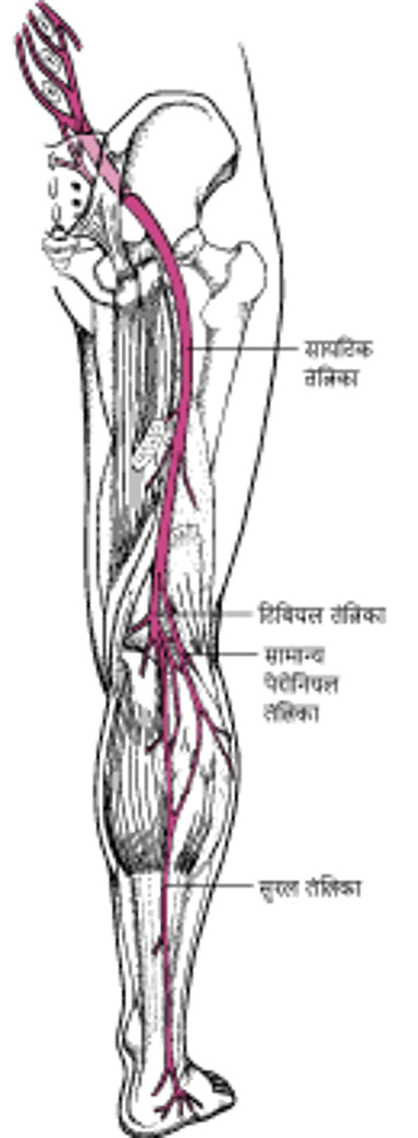 साइटिका