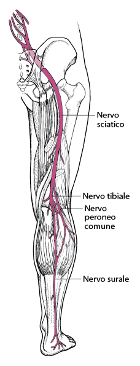 sciatica