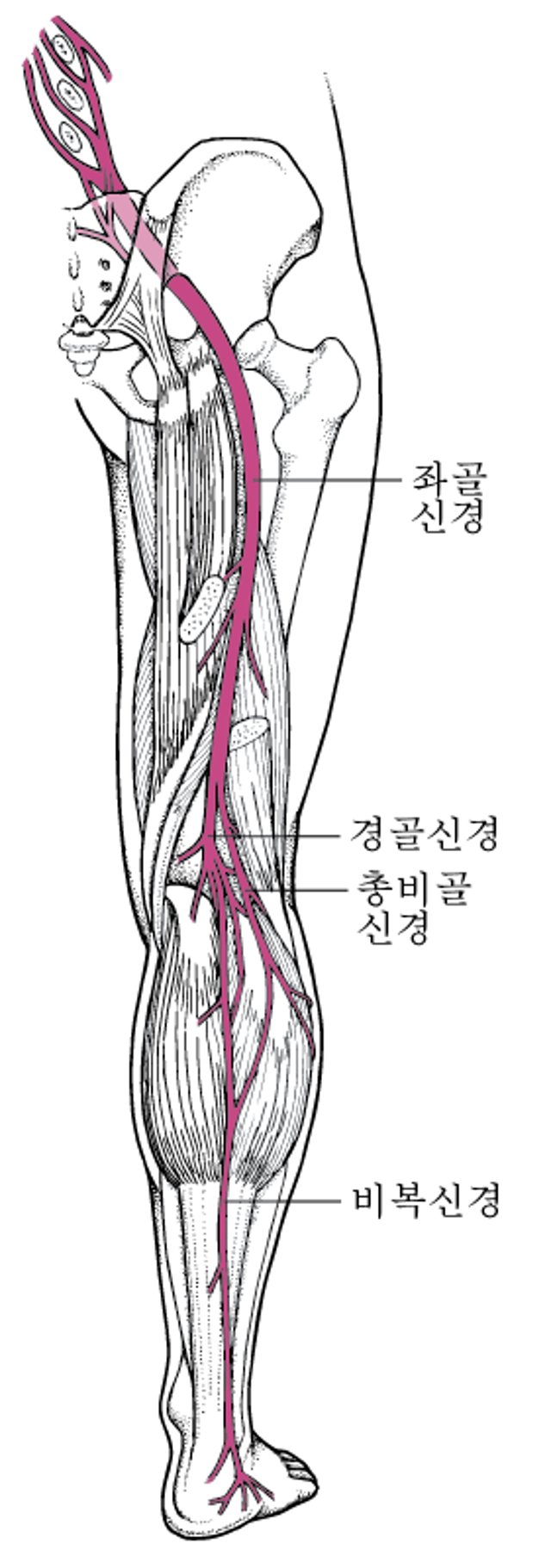 좌골신경통