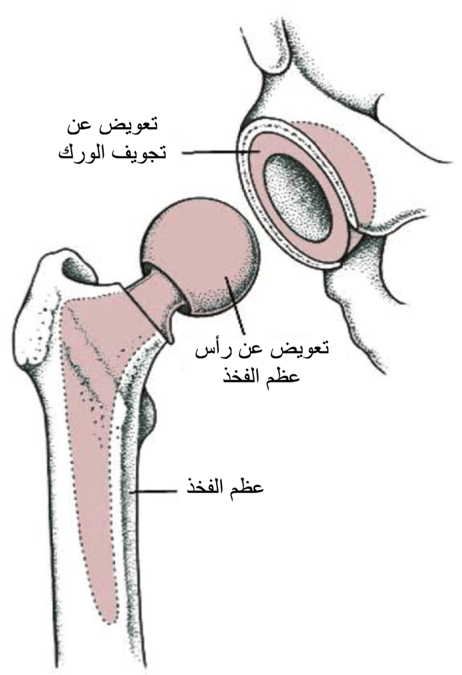 استبدالُ كامل مفصل الورك (استبدال الورك التام)