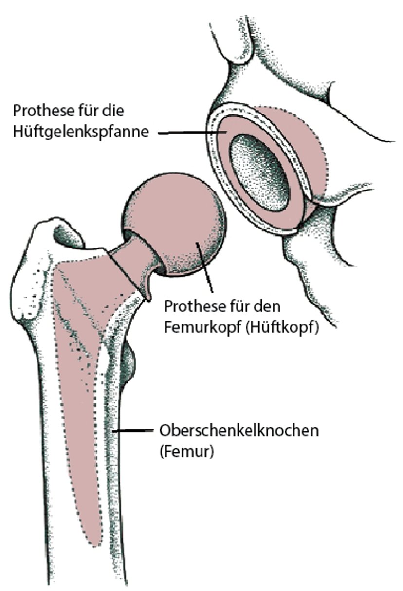 Ersetzen der kompletten Hüfte (Hüfttotalendoprothese)