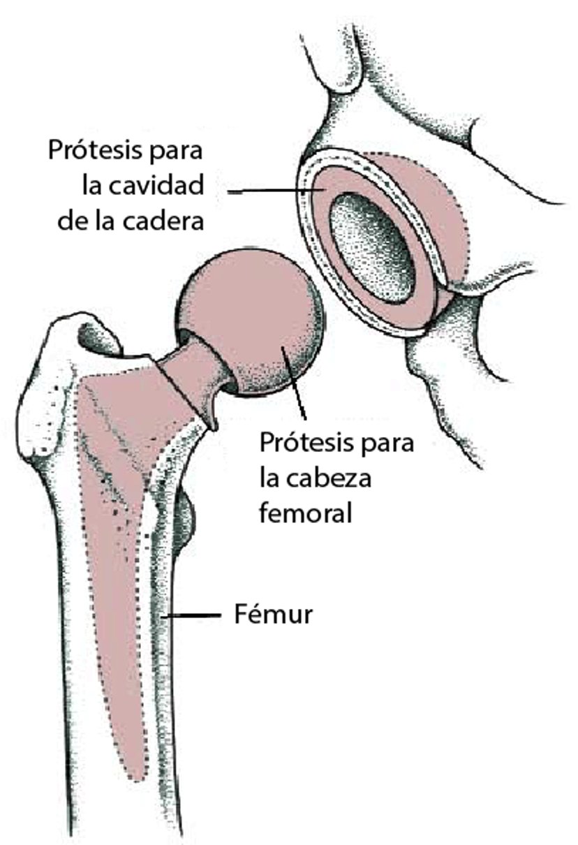 Prótesis de cadera (reemplazo total de cadera)