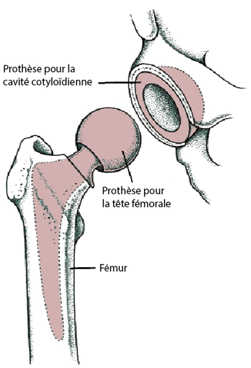 Remplacement total de la hanche (pose d’une prothèse totale de la hanche)