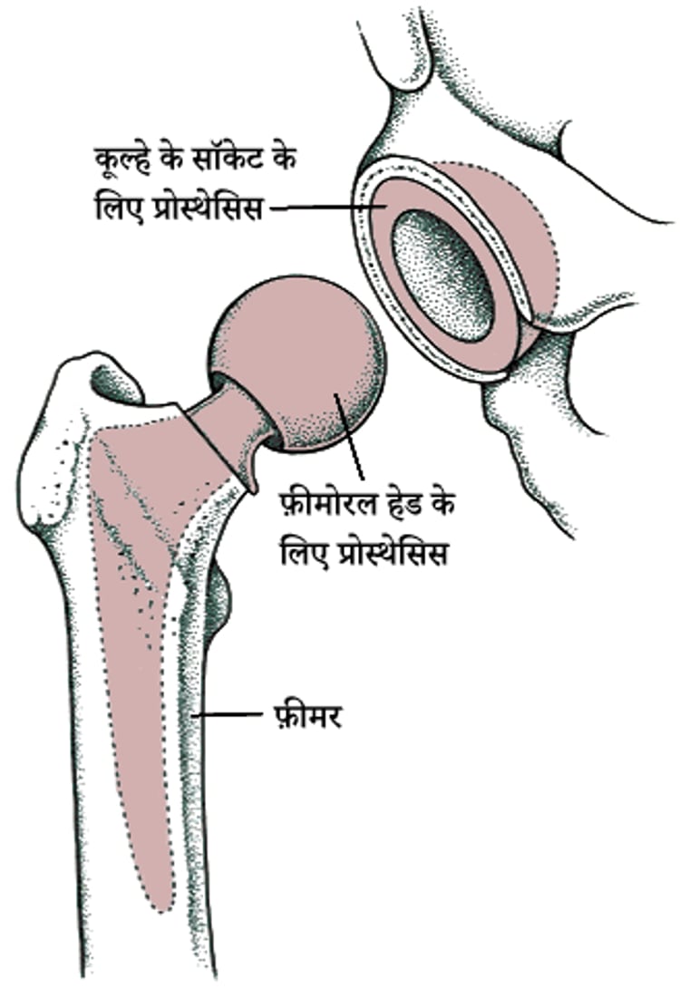 पूरे कूल्हे को बदलना (टोटल हिप रिप्लेसमेंट)