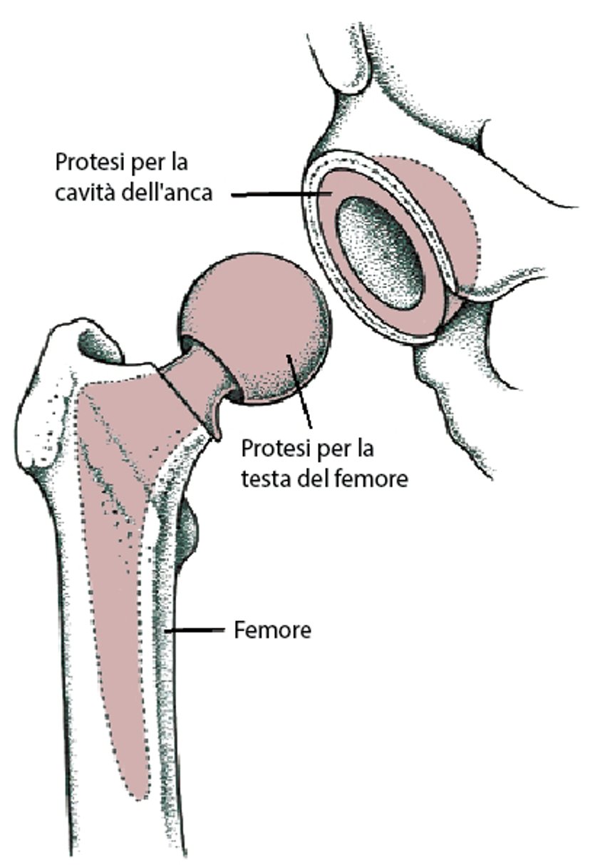 Sostituzione di tutta l’anca (sostituzione totale dell’anca)