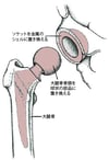股関節全体の置換手術（人工股関節全置換術）