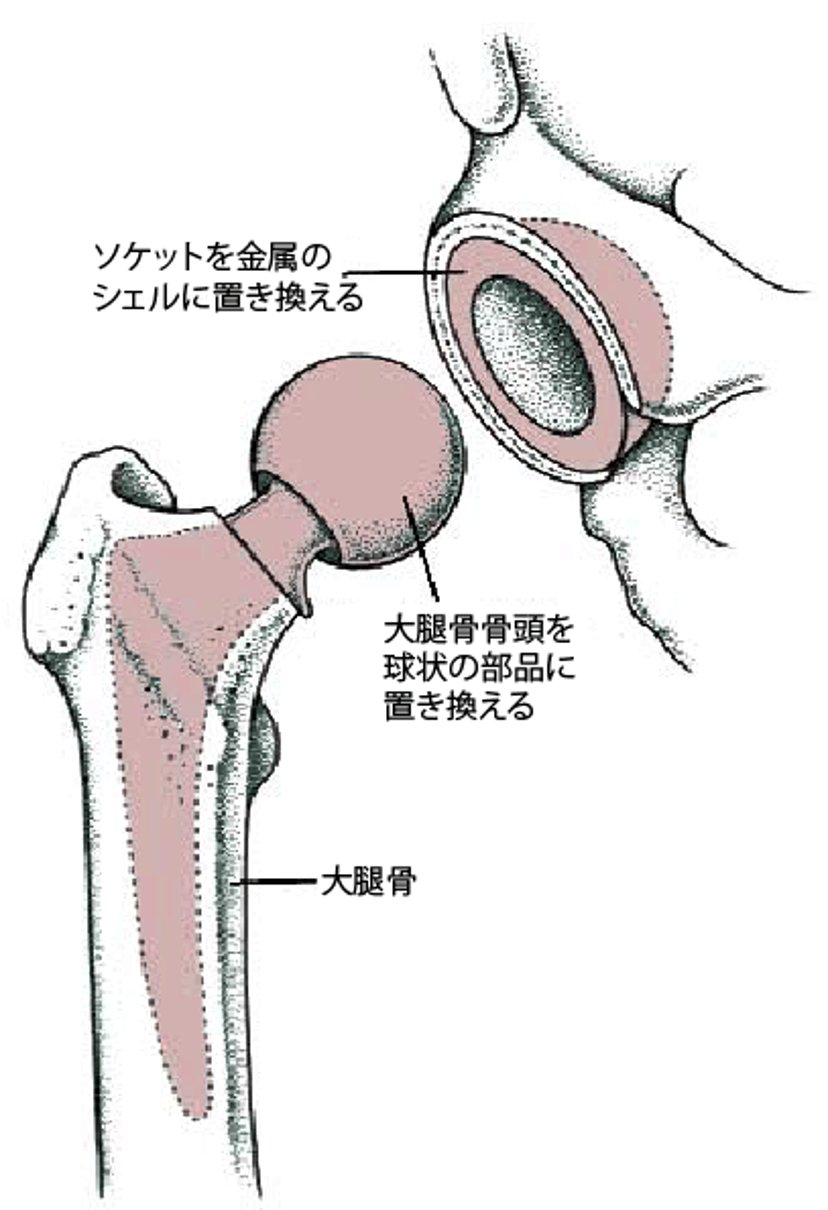 股関節全体の置換手術（人工股関節全置換術）