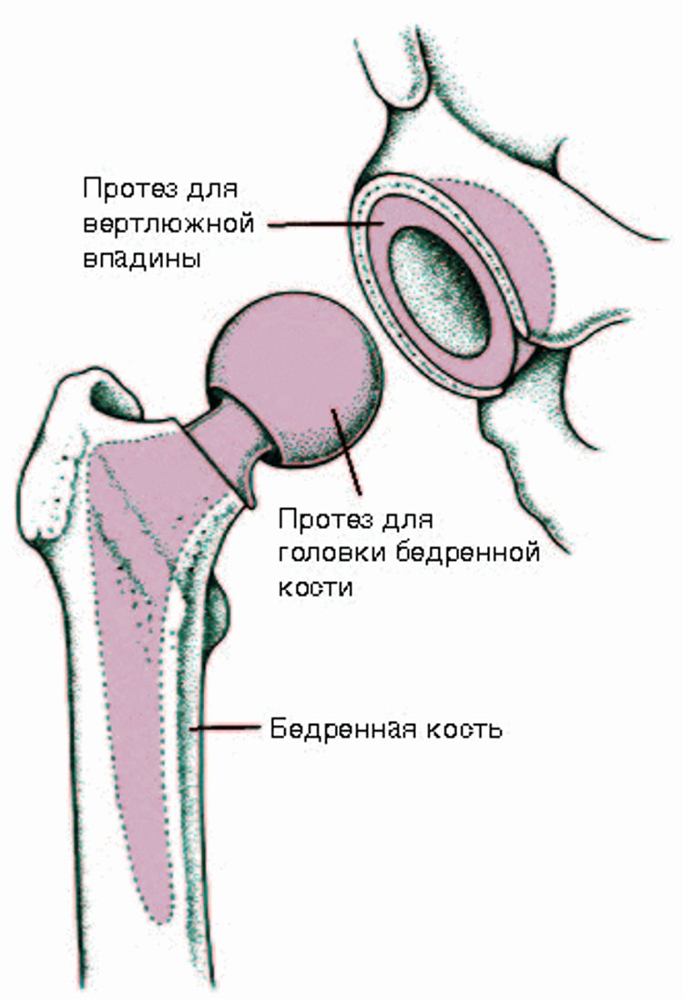 Полная замена тазобедренного сустава