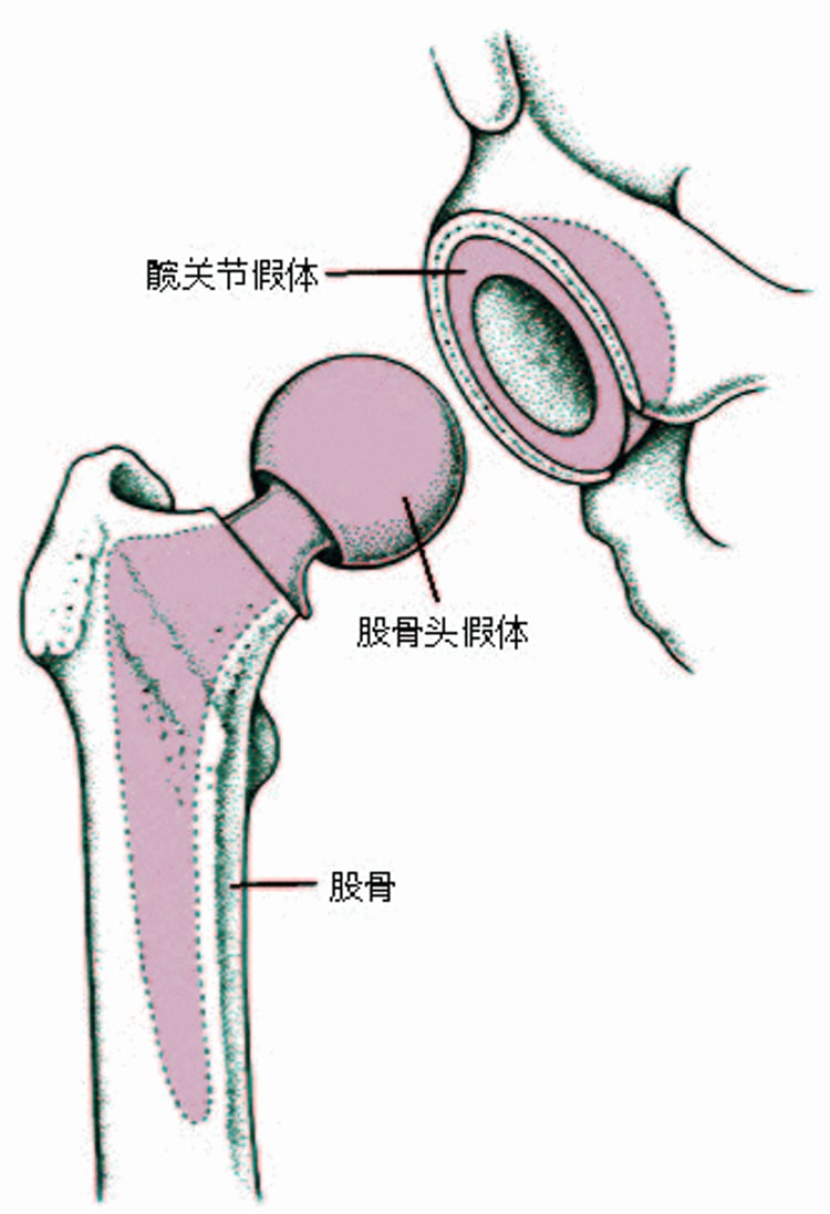 置换全部髋关节（全髋关节置换）